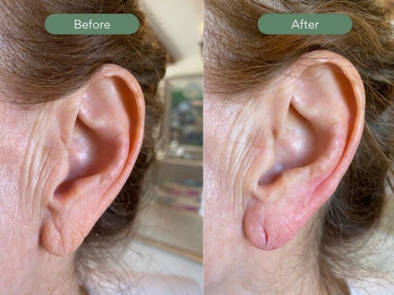 Before and After Ear Lobe Filler