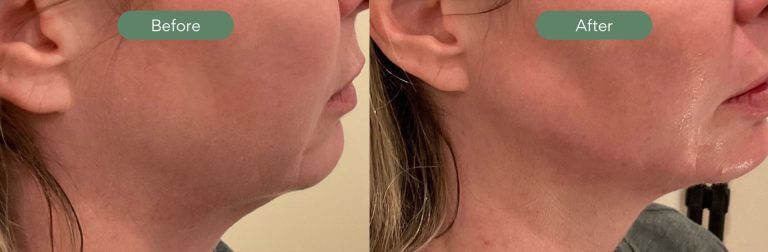 Injected Artistry Before and After Jawline Filler