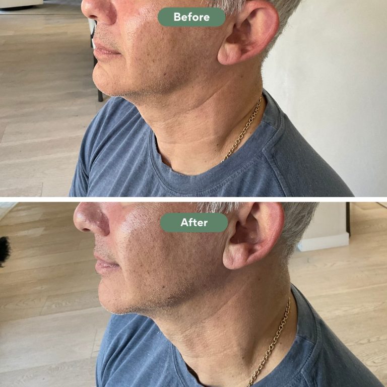 Injected Artistry Jawline Augmentation