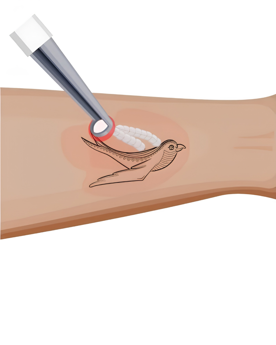 Laser Tattoo Removal product photo