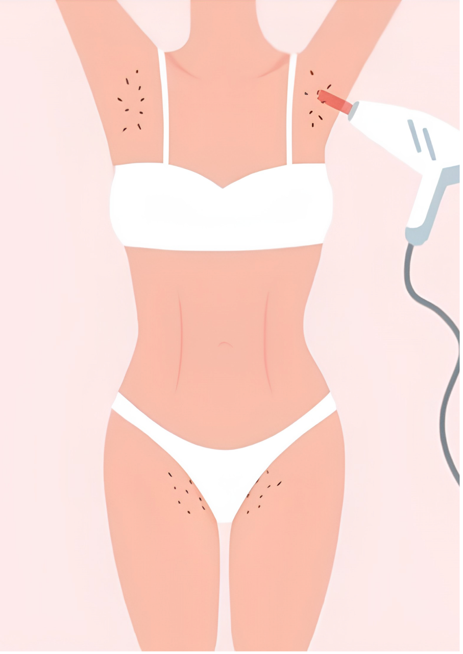 Laser Hair Removal photo